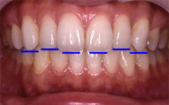 ポイント2 上前歯の切端ライン