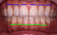 ポイント3 歯頸部（歯肉部）ライン